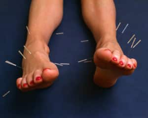 acupuncture - traditional Chinese medicine