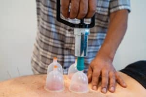 Acupuncture - cupping