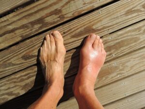 Got Gout? How to Relieve the Excruciating Pain Now and Keep it Away - get help with gout at Natural Medicine & Detox, Phoenix, AZ
