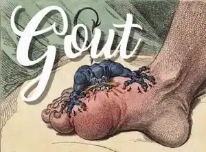 Got Gout? How to Relieve the Excruciating Pain Now and Keep it Away - get quick relief from gout at Natural Medicine & Detox, Phoenix